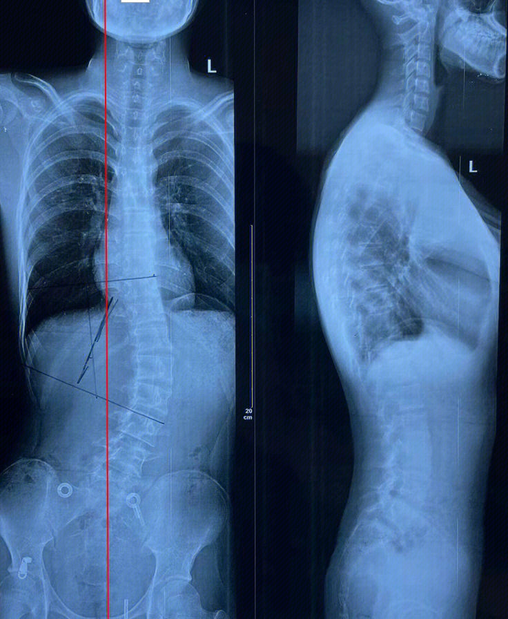 脊柱侧弯剃刀背图片