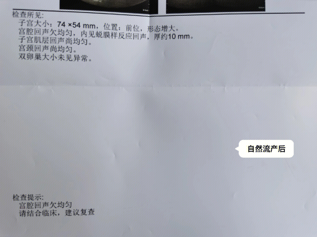 检查有霉菌性阴道炎所以开了冲洗液回家三天后复查准备住院做稽留流产