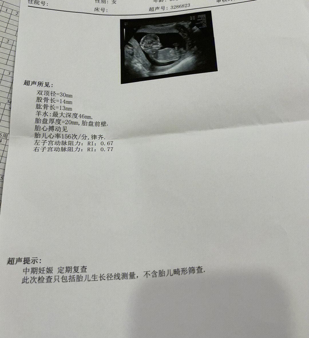 胎儿股骨短图片