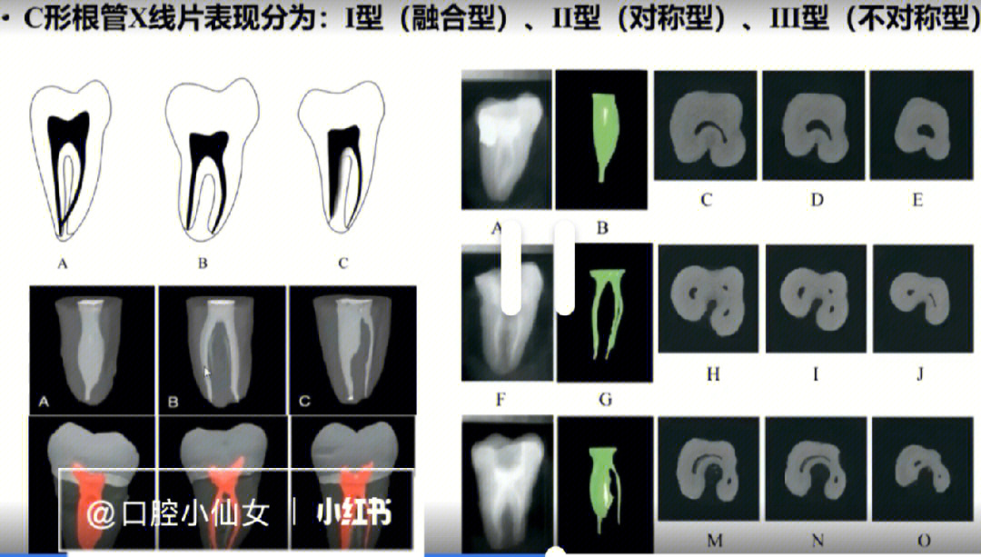c形根管形态图片