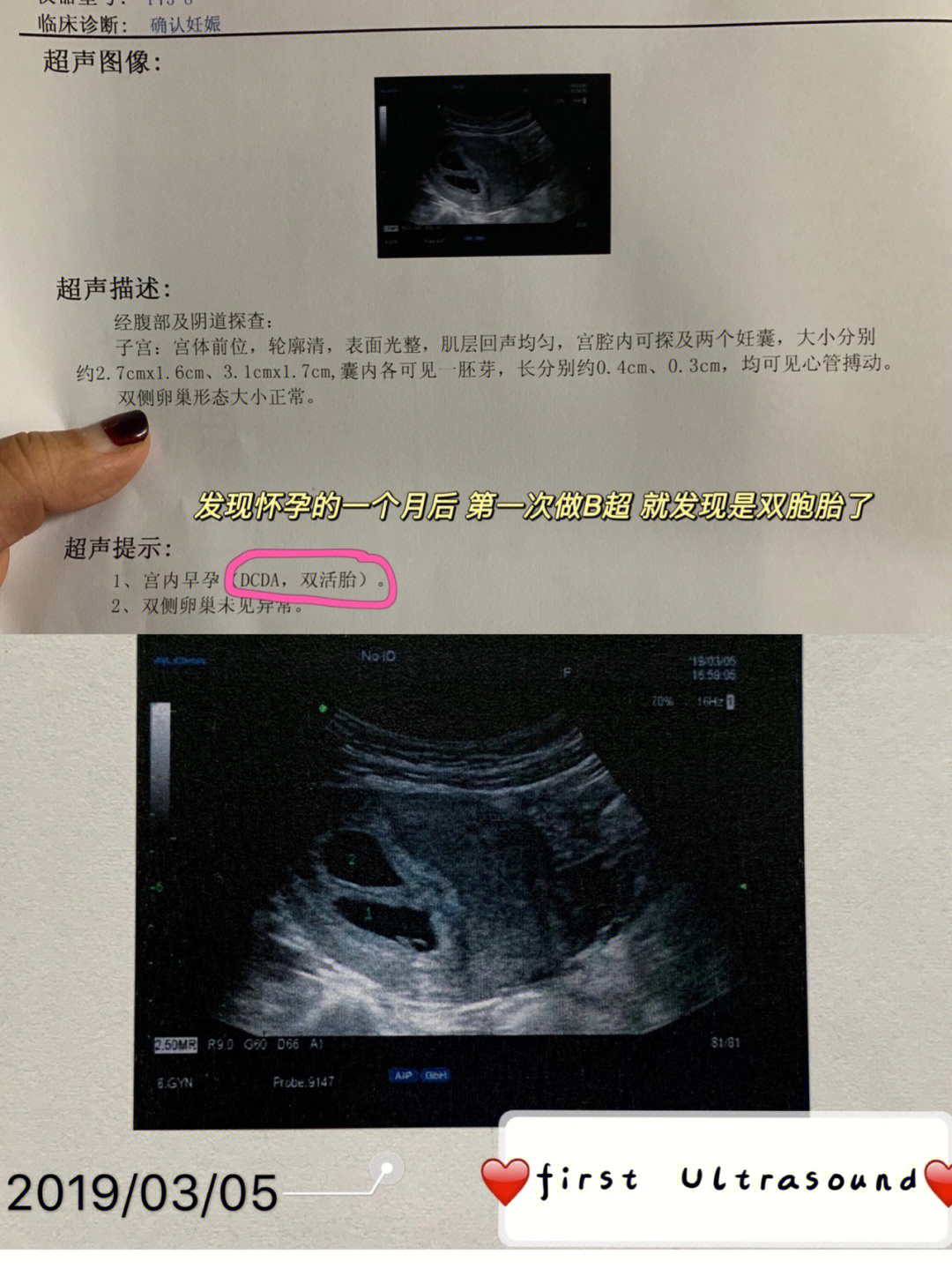 男孩胎囊图片 两个月图片