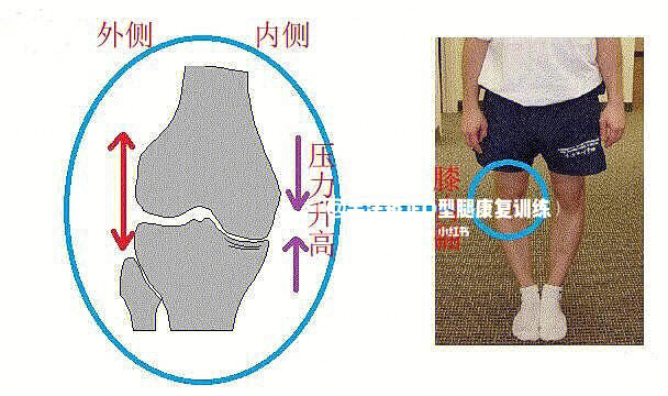 0型腿怎么矫正图解图片