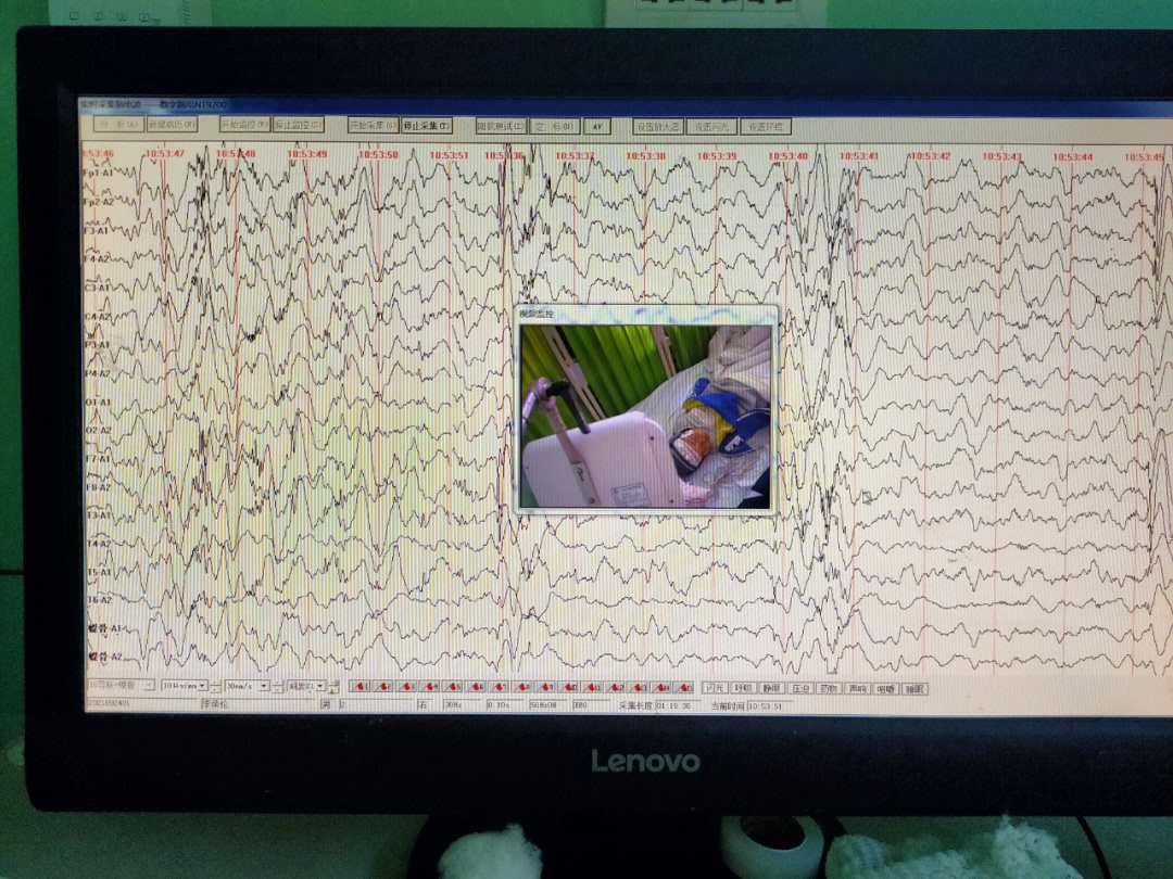 帮忙看孩子脑电图