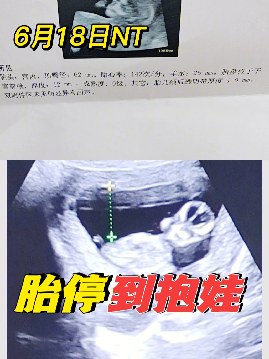 人流胎儿7月图片