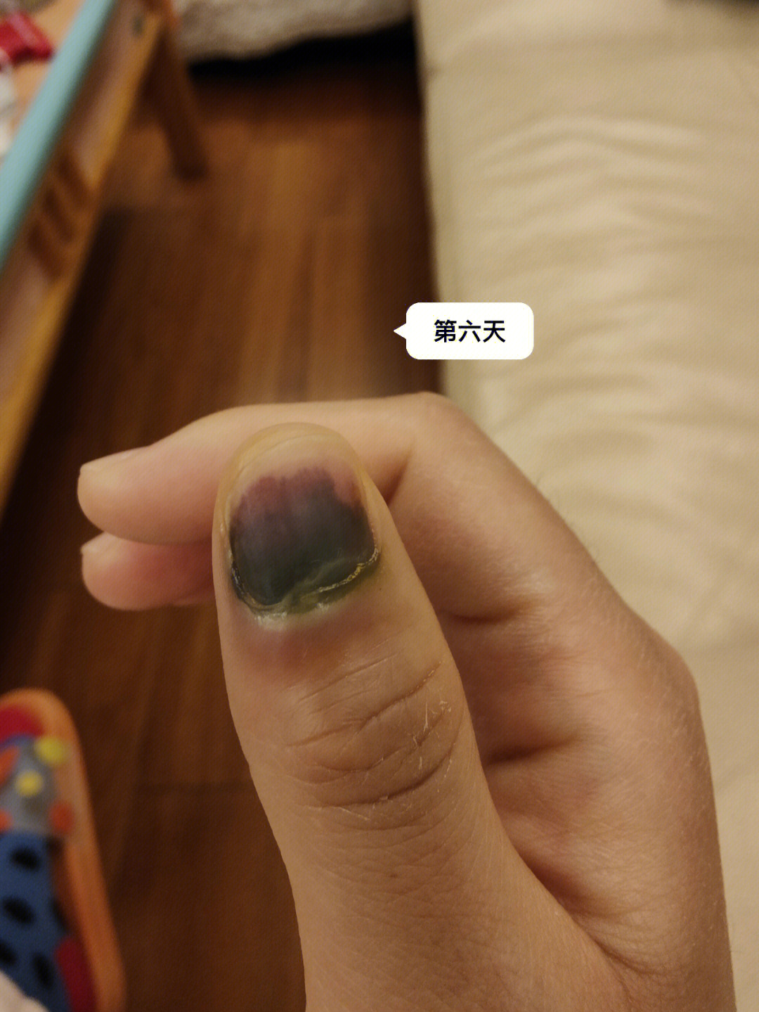 紫薇被夹手指图片
