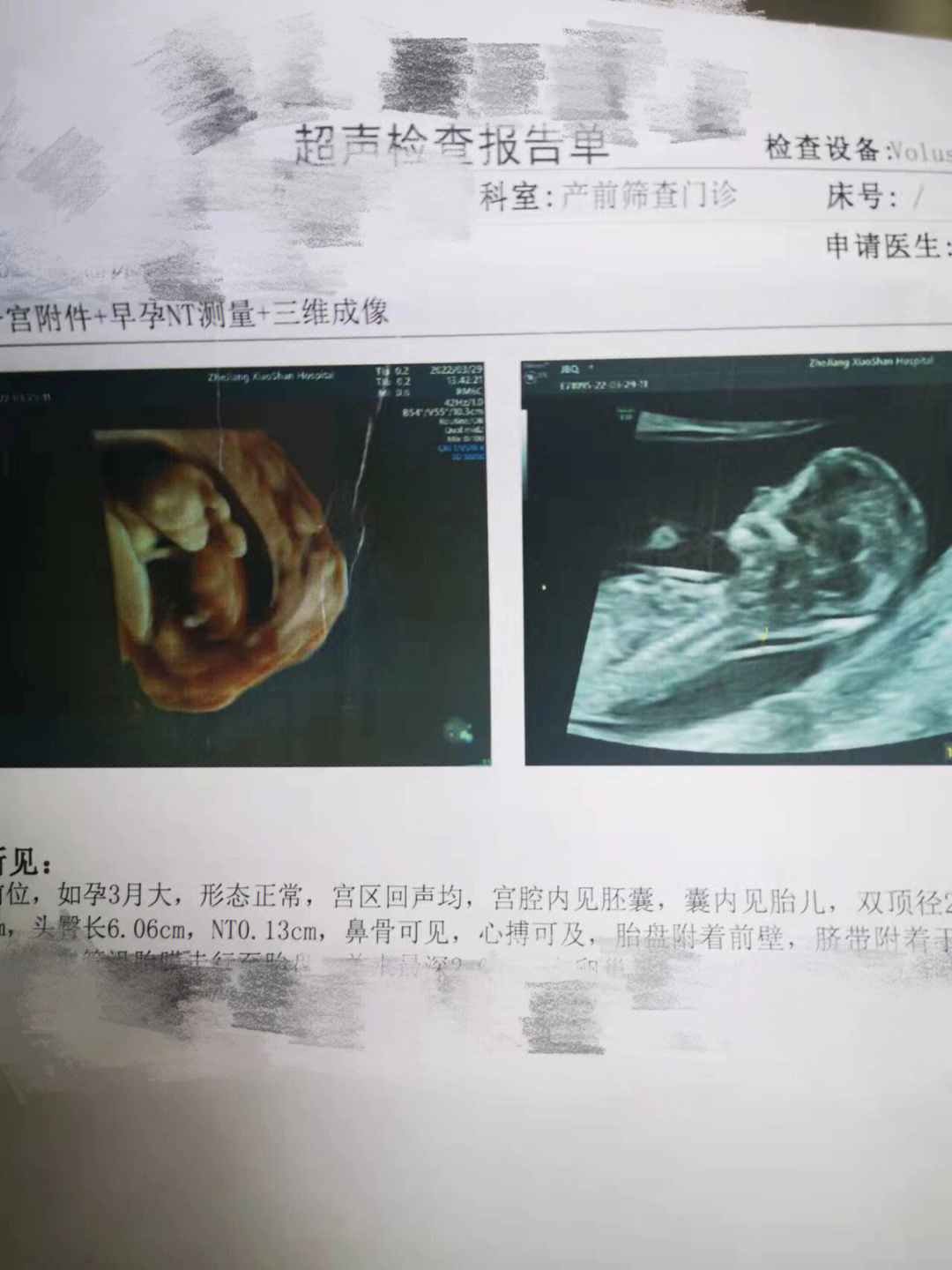 孕12周胎儿大小标准图片