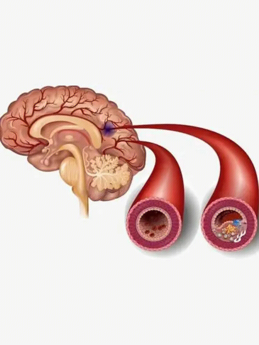 脑梗或冠心后,是吃地龙蛋白还是水蛭素?它俩有啥区别?