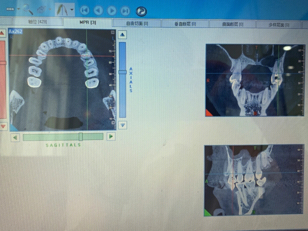 牙齿ct怎么看图解图片