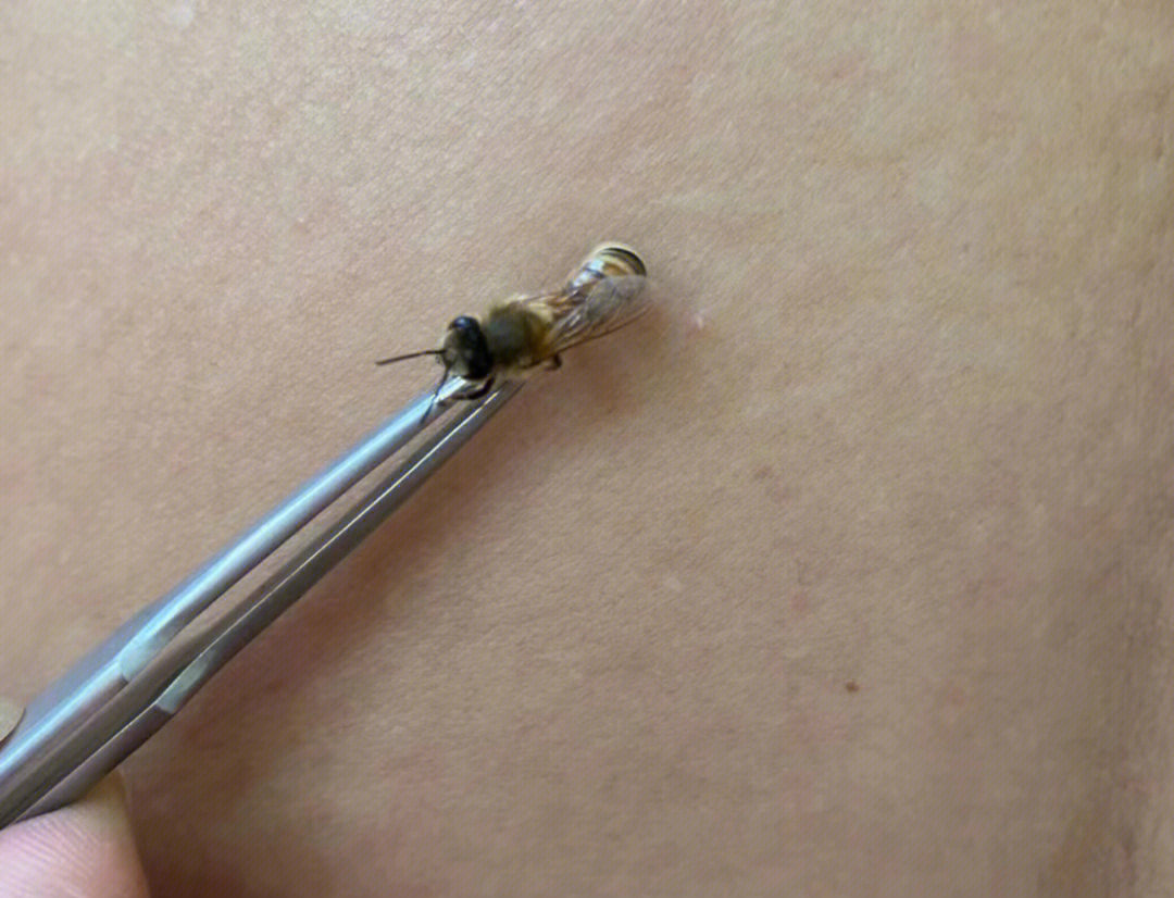 蜂刺疗法就是将蜂针液的药理作用与针灸学原