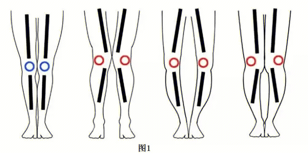 腿型问题分析
