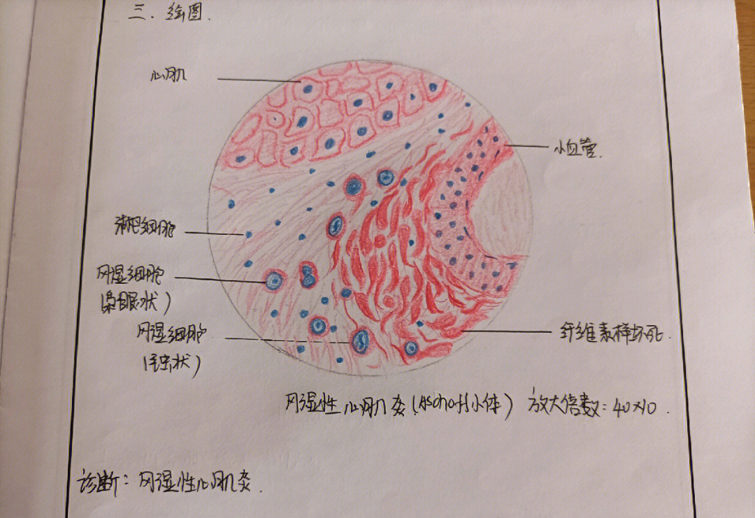 风湿性心肌炎&冠状动脉粥样硬化