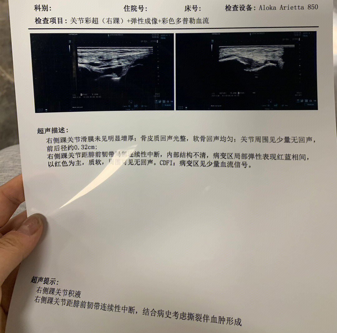 腓总神经超声图图片