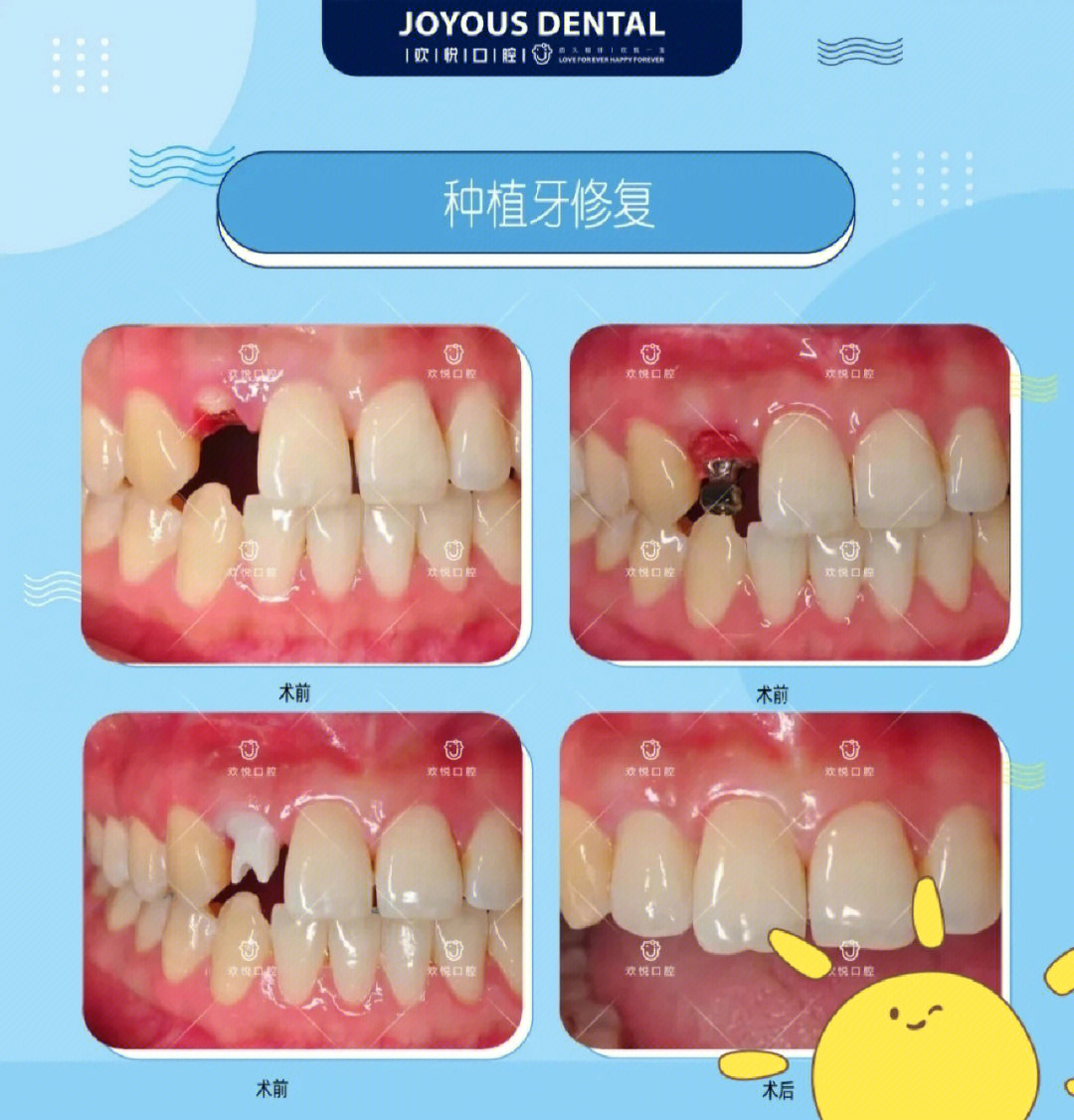 欢悦口腔种植牙案例分享