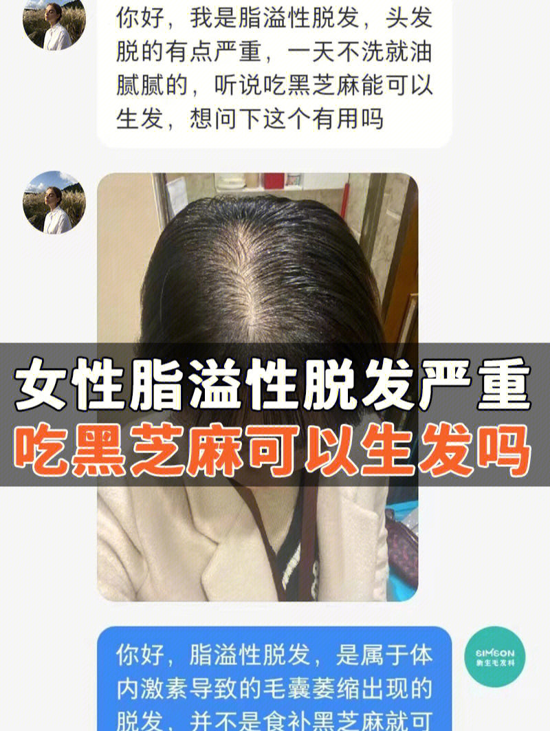 脂溢性脱发能长回来吗图片