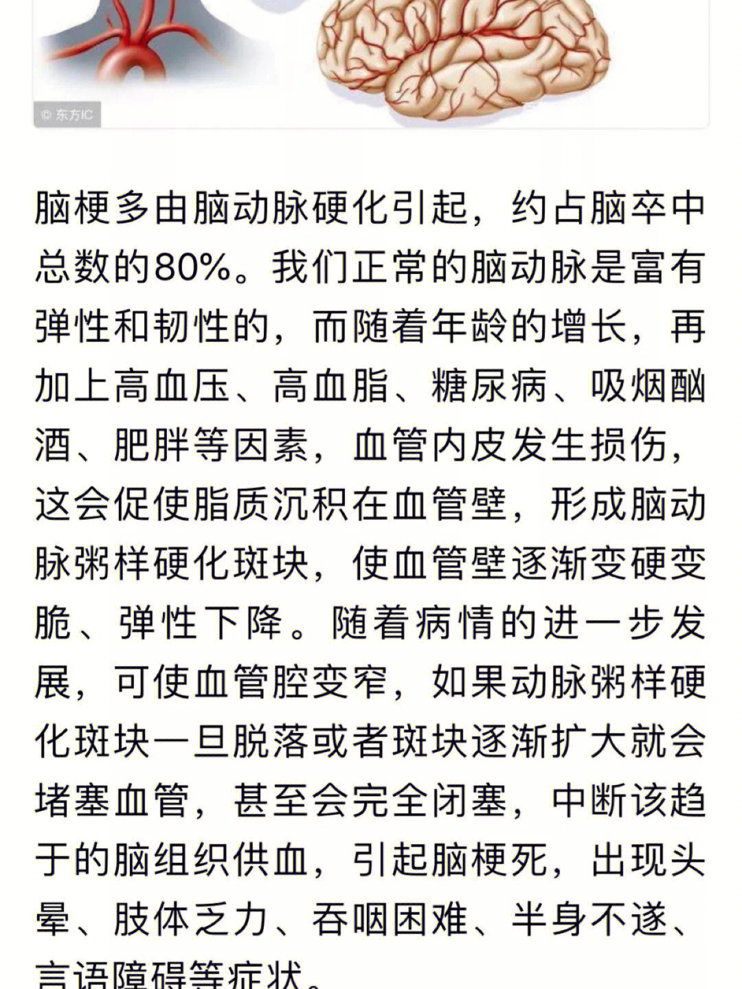 脑梗,即脑梗死,是缺血性脑卒中的总称,主要包括脑血栓形成,腔隙性梗死