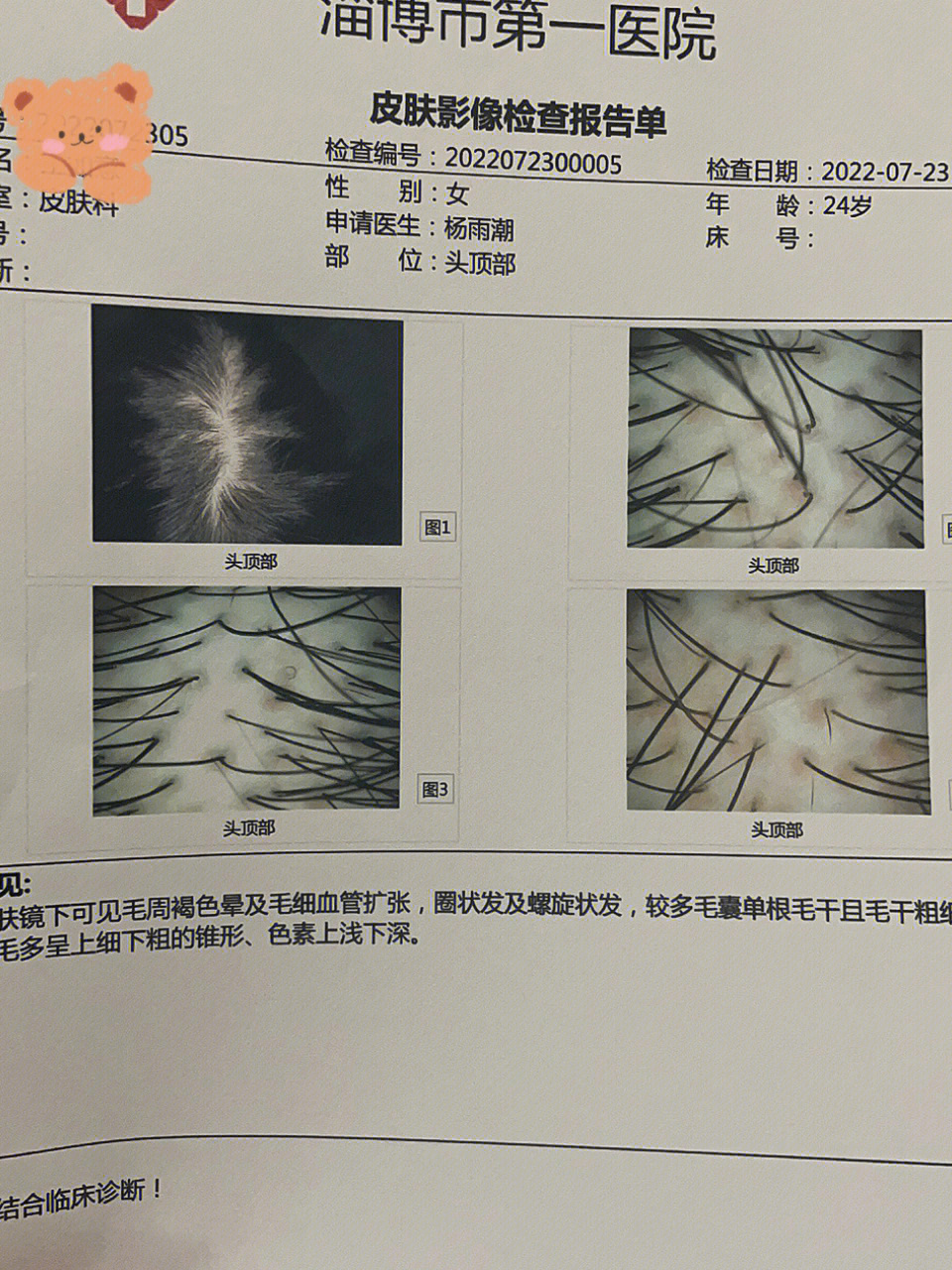 最近脱发特别严重,去医院检查了一下,医生说是因为我减肥毛囊进入了