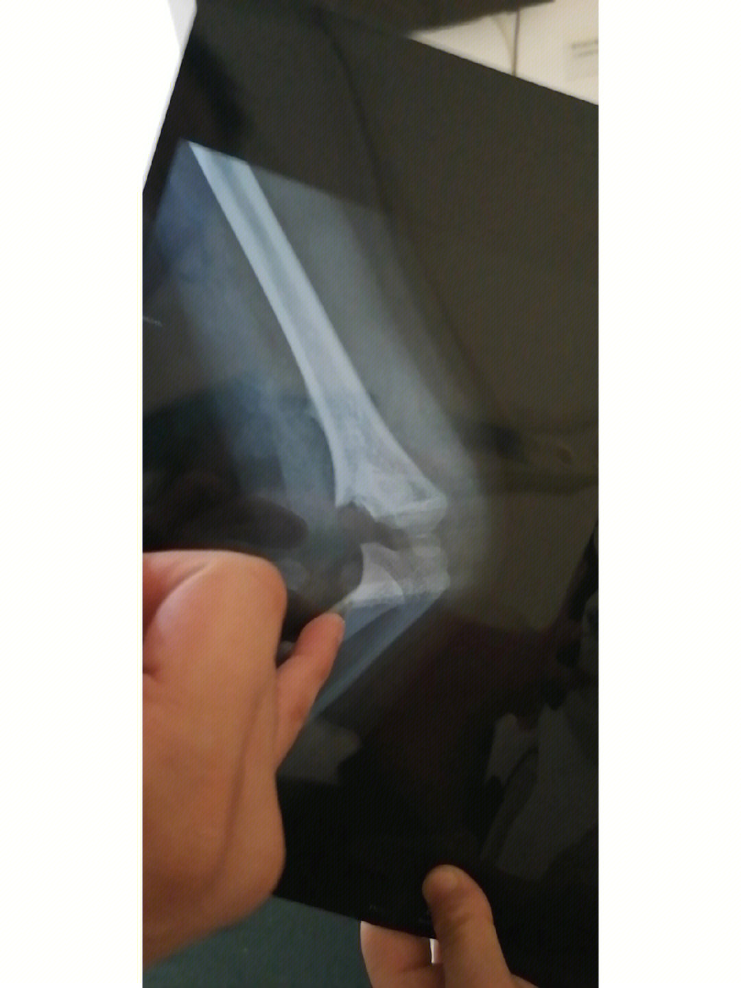 小孩右手肱骨骨折图片图片