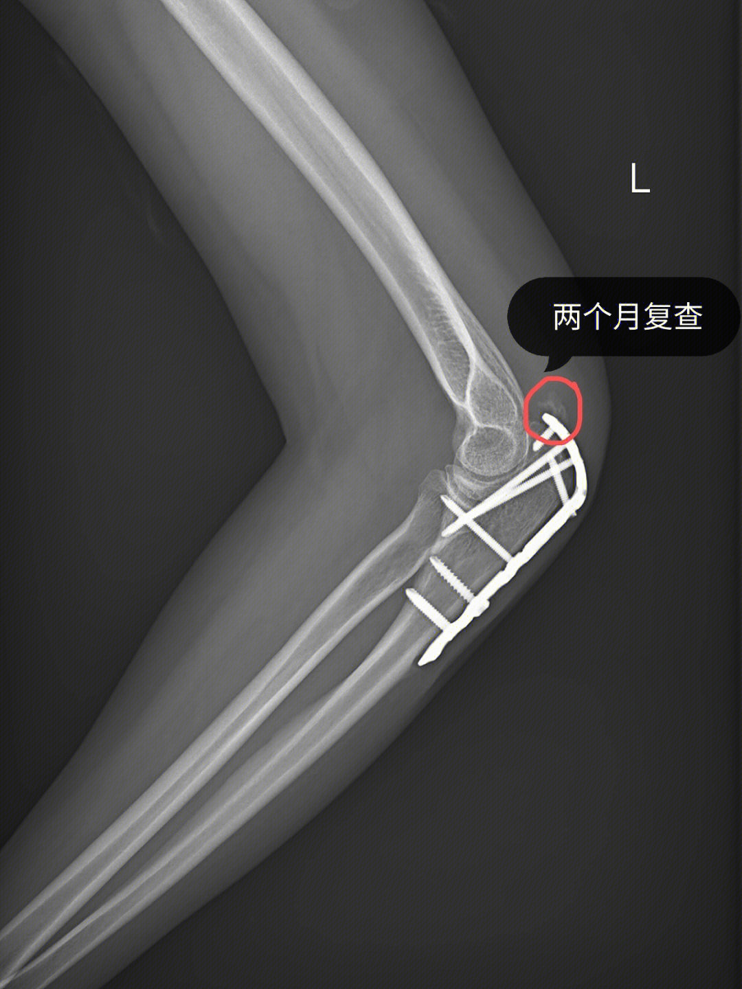 鹰嘴骨折术后两个月复查