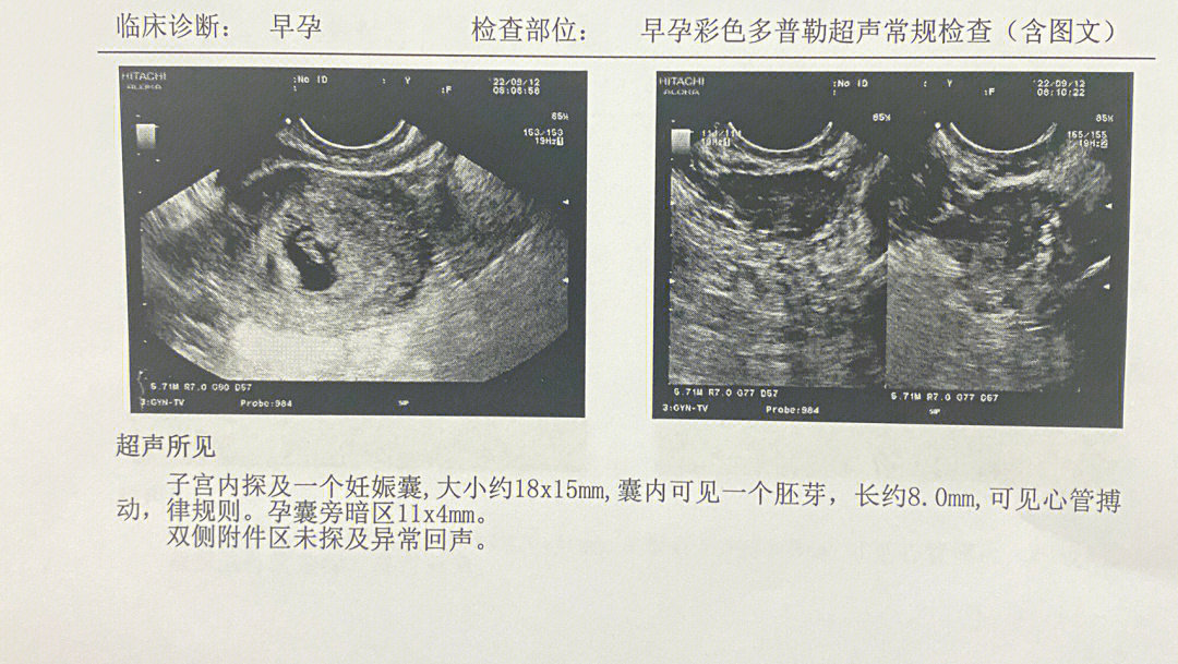 三胞胎孕囊图片图片