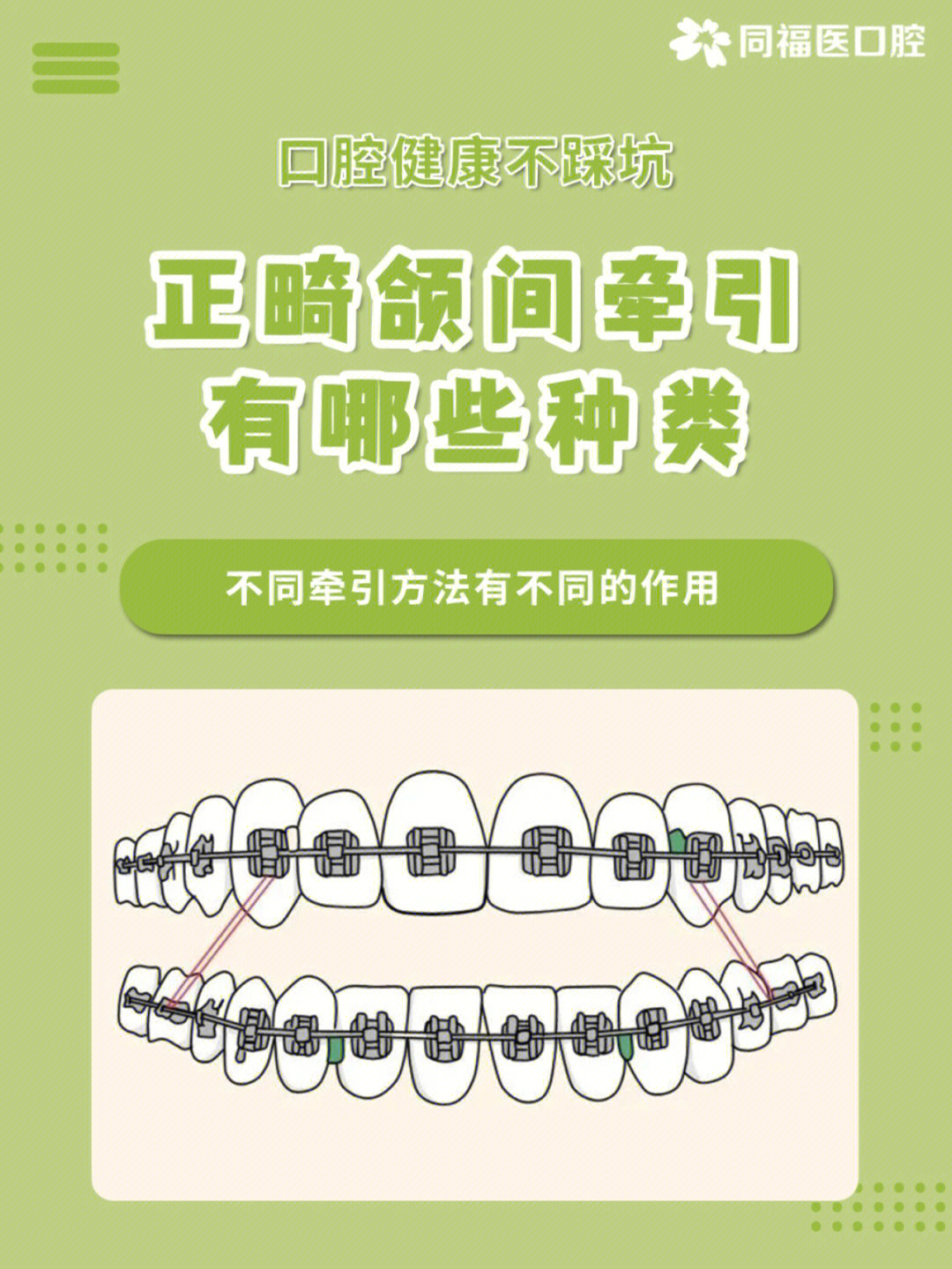 正畸颌间牵引有哪些种类整牙科普口腔