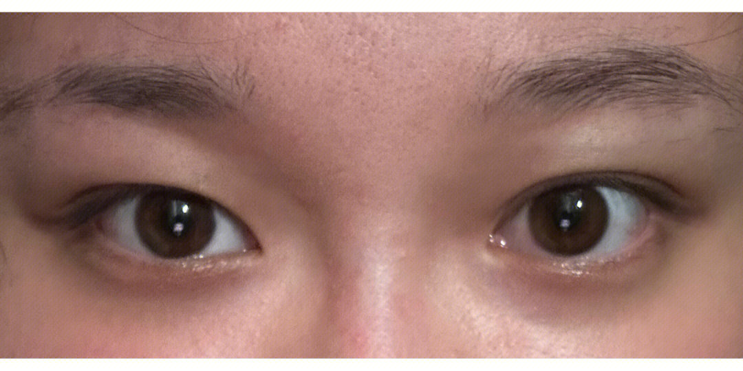 (应该是然后我想去割个眼皮,因为本身眼皮有点脂肪堆积,然后下垂压