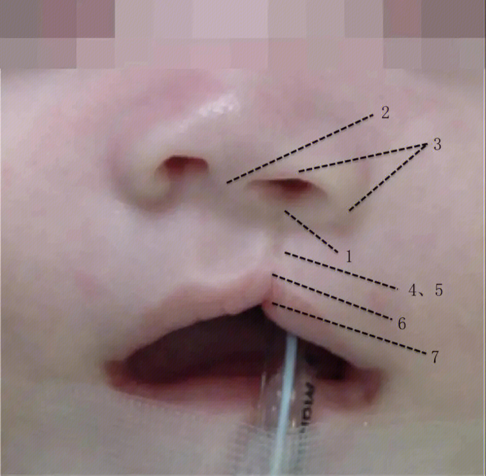 胎儿嘴角裂缝畸形图片图片
