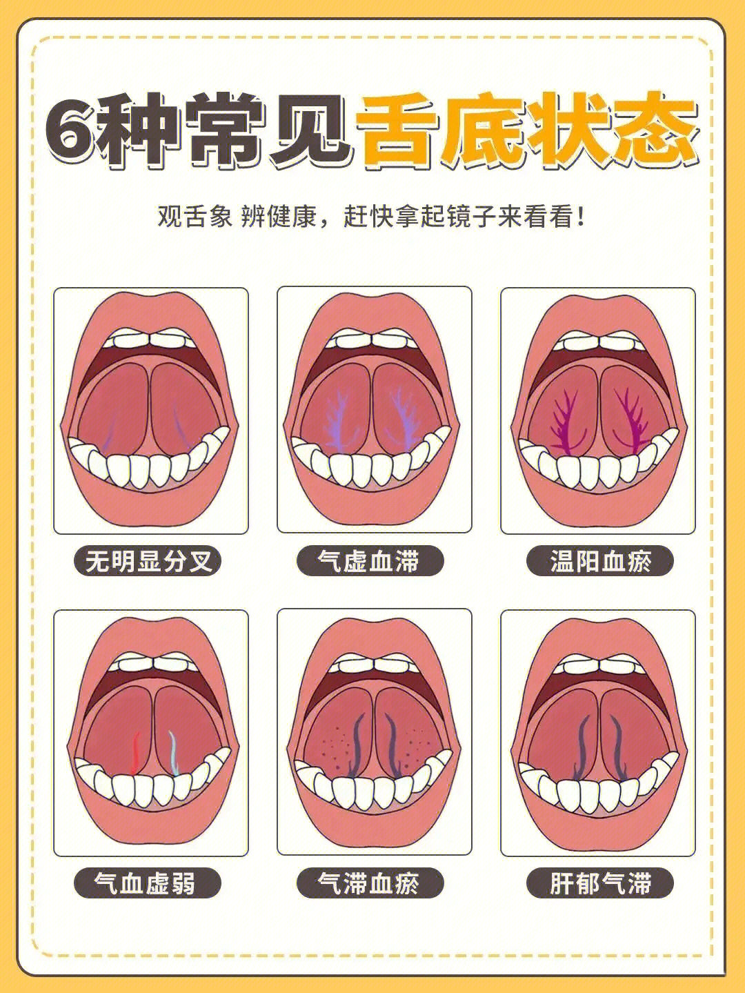 舌下静脉瘀堵四级图片