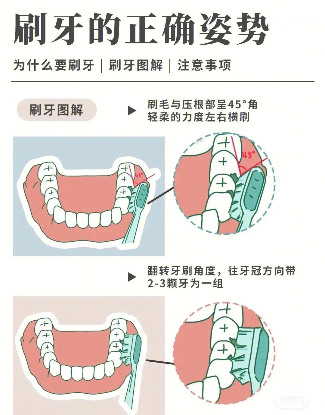 刷牙不仅不能达到保护牙齿的目的,还有可能引起牙龈萎缩等牙周疾病