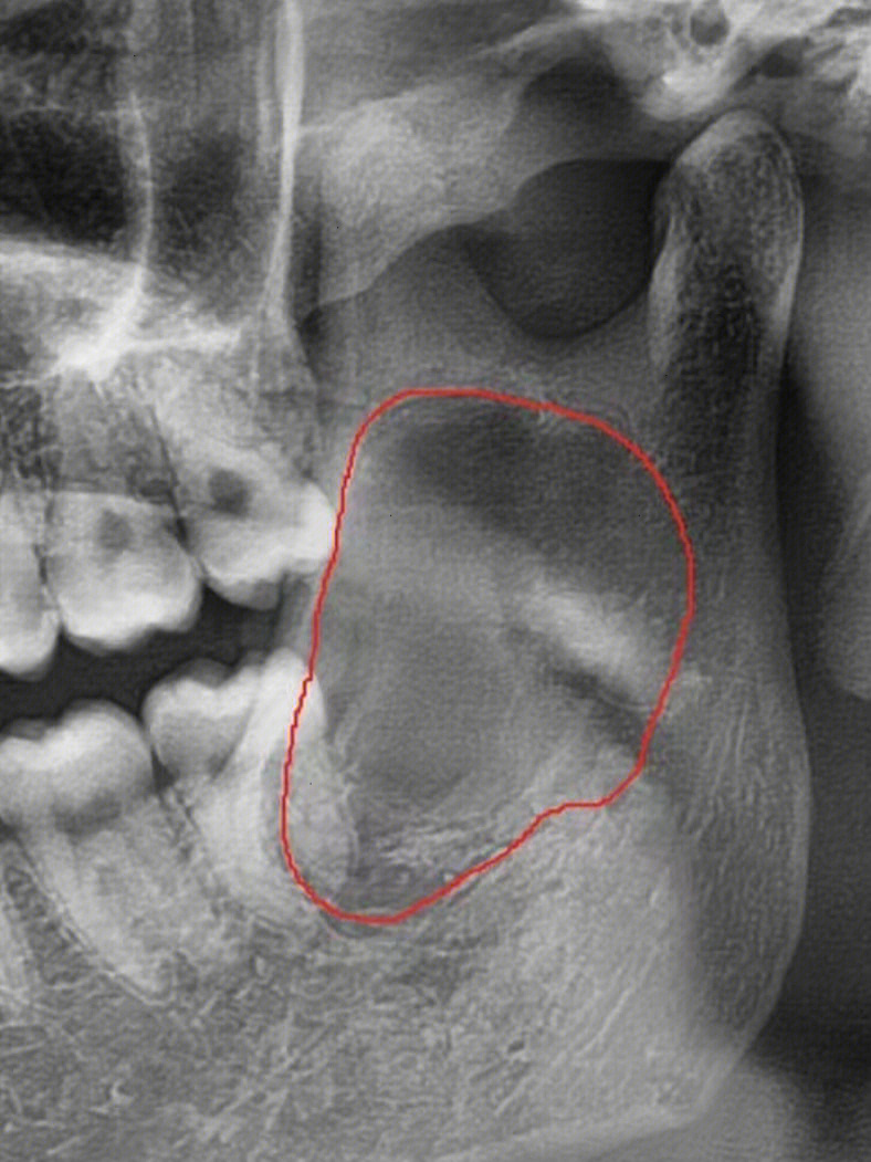 牙囊肿不治疗的后果图片