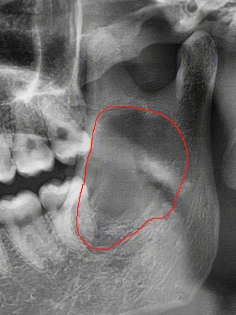 牙囊肿拍片图图片