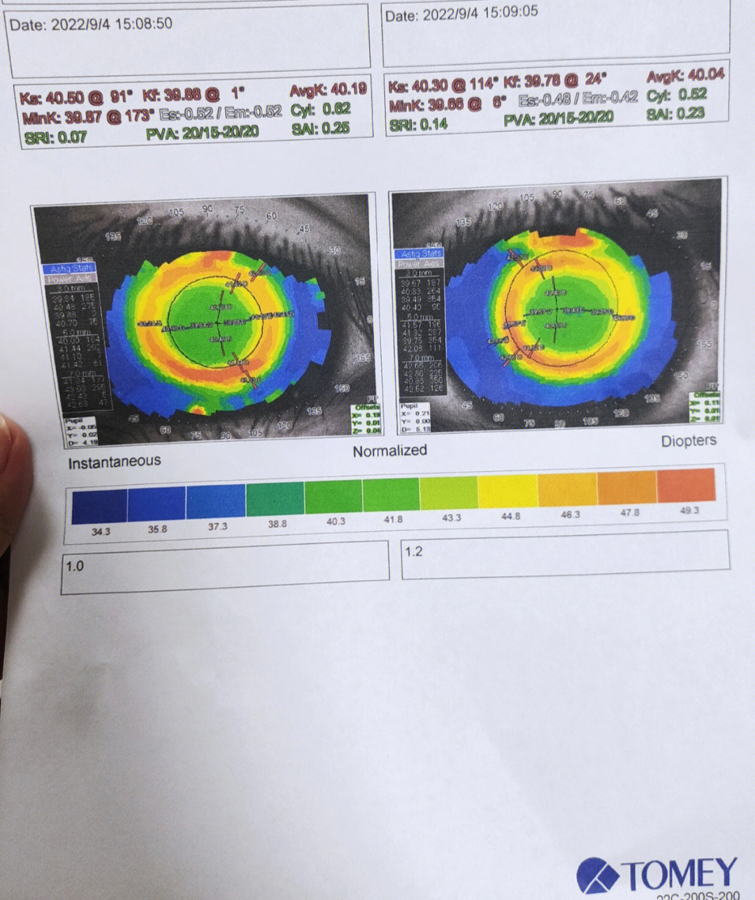 角膜地形图复查图片