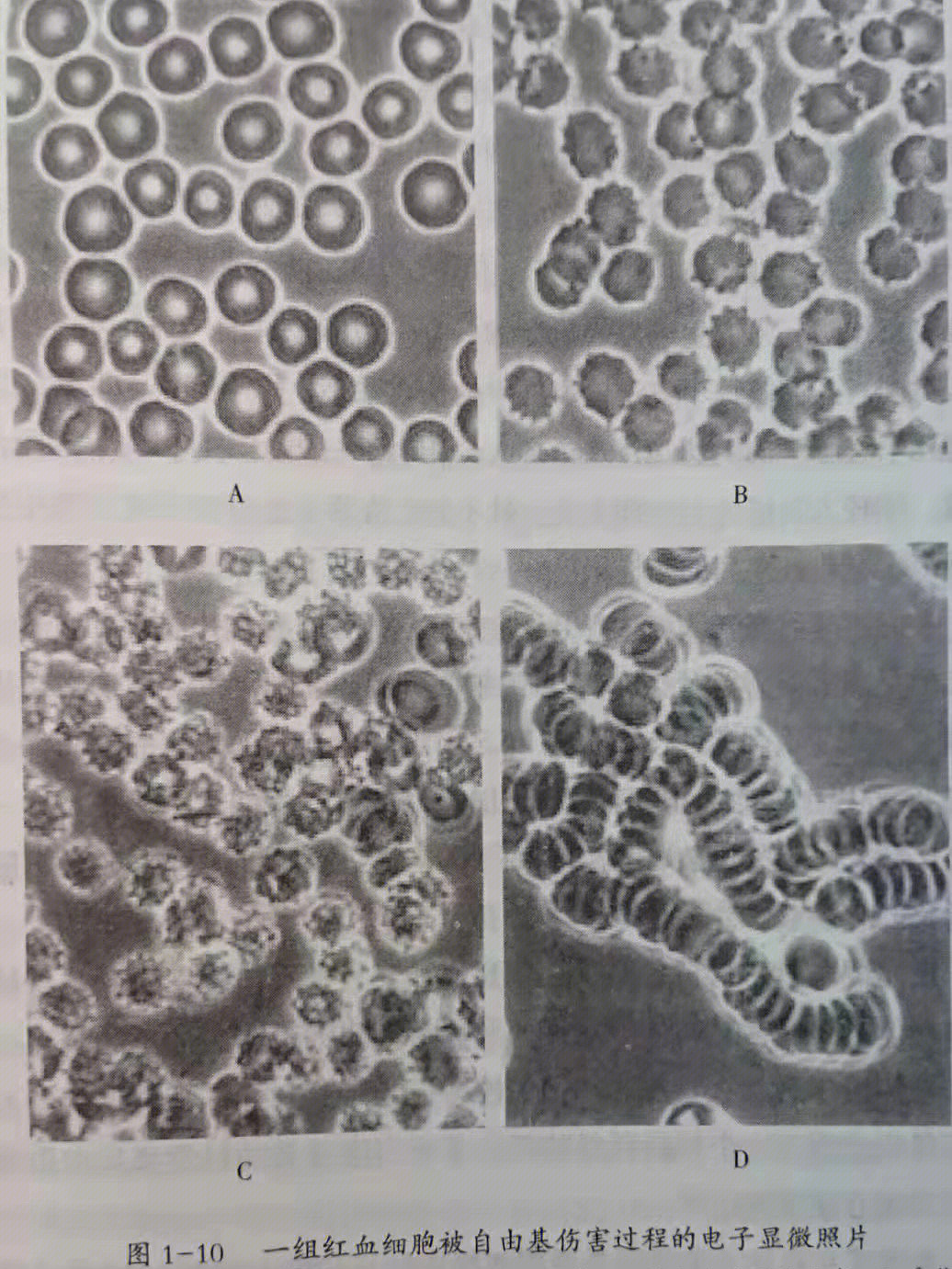 红细胞叠连图片图片
