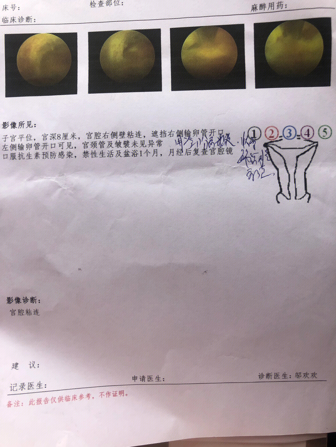 做个宫腔镜检查顺带就做了分离宫腔黏连手术