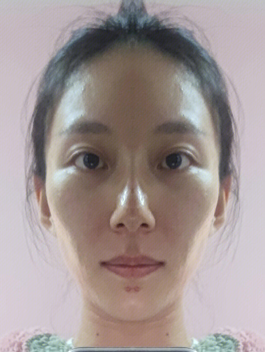 左右脸不对称 训练两天的后续