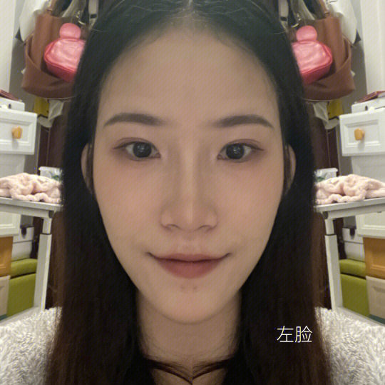 应该没有比我左右脸更不对称的了吧